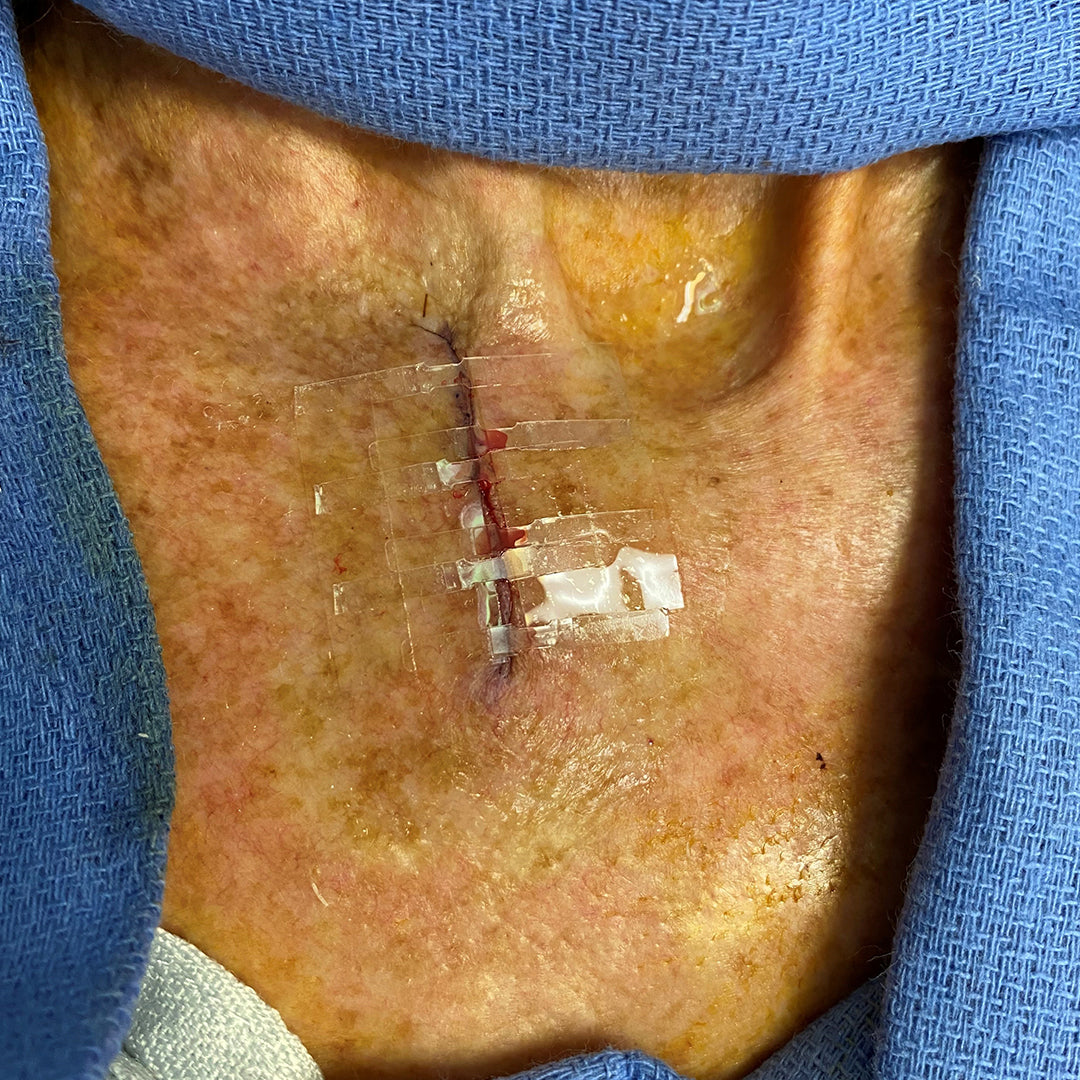 For Surgeons – Clozex Medical, Inc.